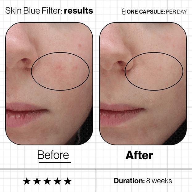 Resultater med Skin Blue Filter på 8 uger